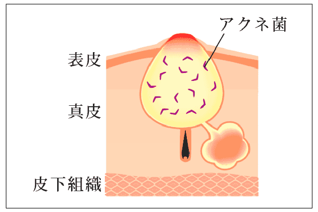 ニキビの出来る仕組みのイラスト